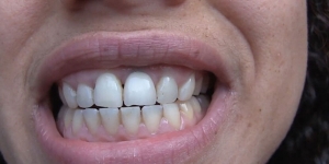Tanden witter maken op een natuurlijke manier